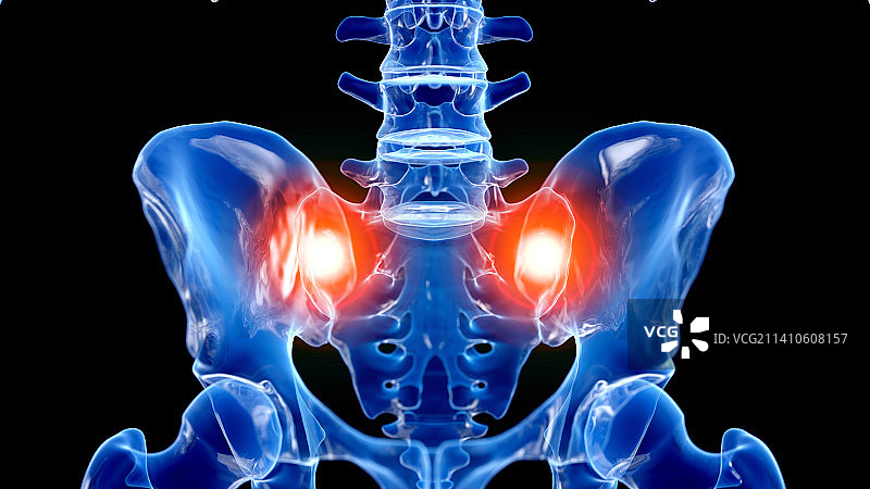 骶髂关节疼痛插图图片素材