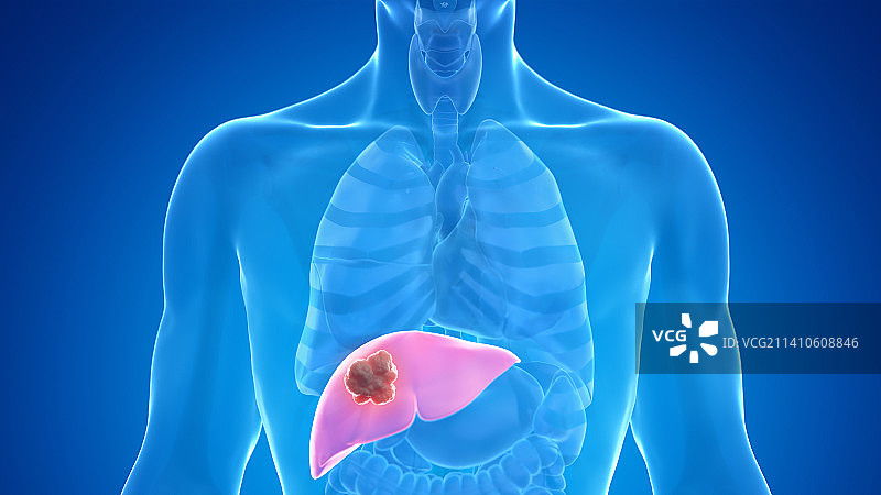肝癌，图示图片素材