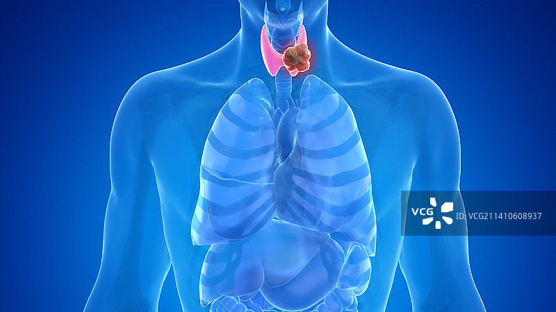 甲状腺癌插图图片素材