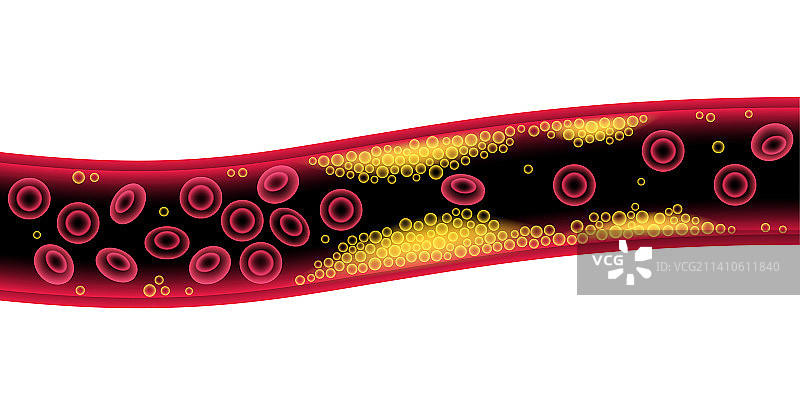 动脉粥样硬化示意图图片素材
