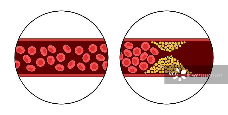 动脉粥样硬化示意图图片素材