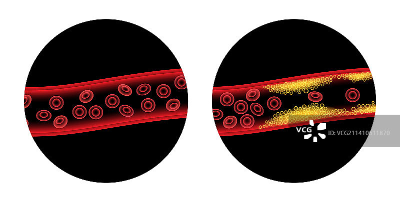 动脉粥样硬化示意图图片素材