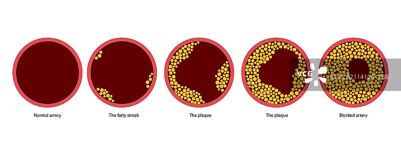 动脉粥样硬化示意图图片素材