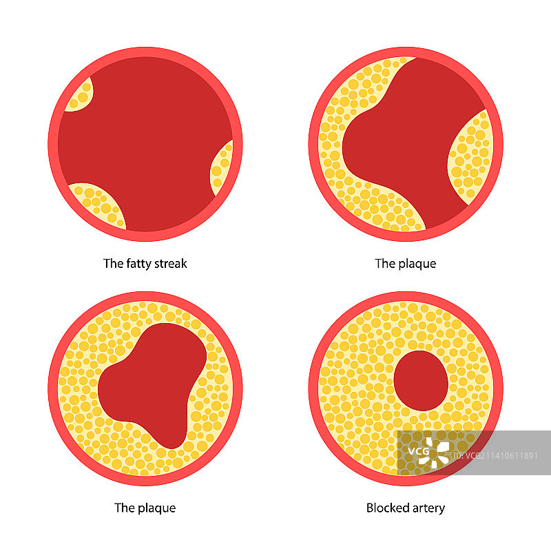 动脉粥样硬化示意图图片素材