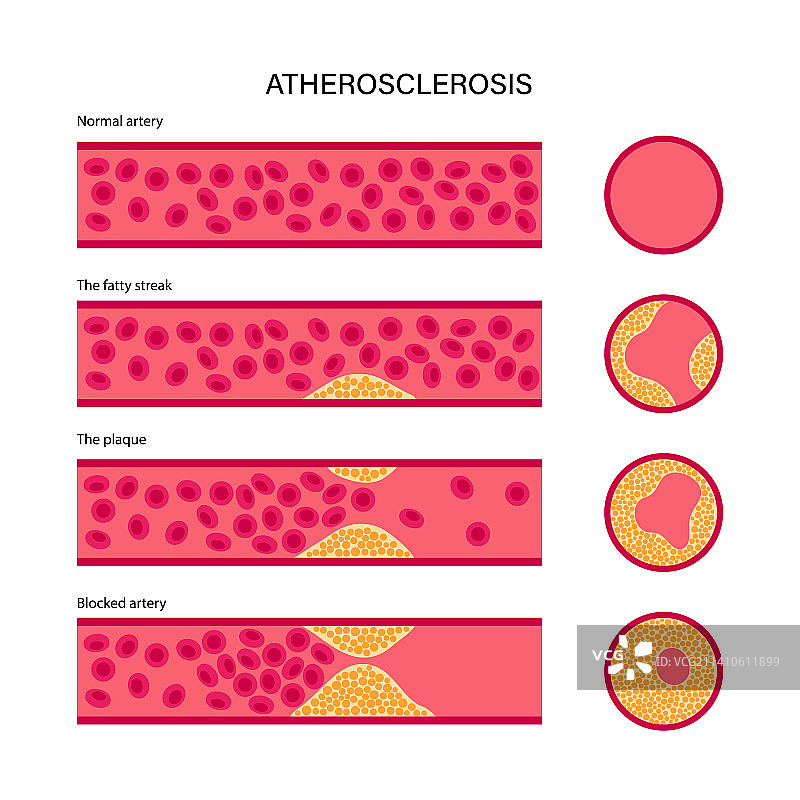 动脉粥样硬化示意图图片素材