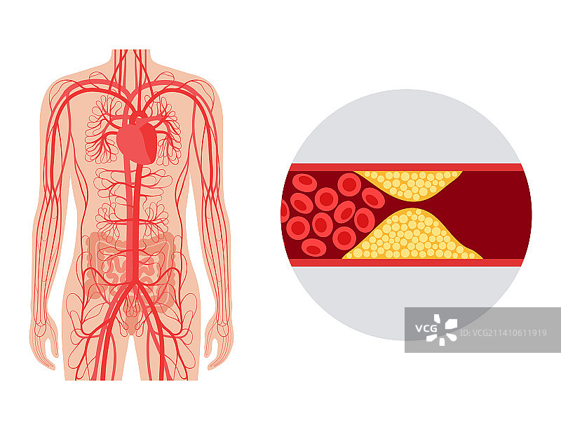 肠系膜缺血插图图片素材