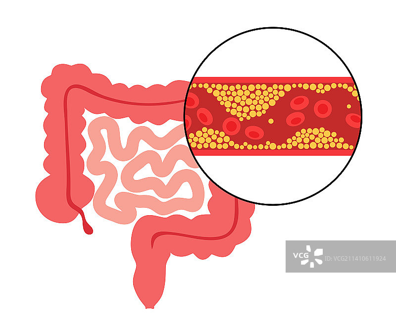 肠系膜缺血插图图片素材