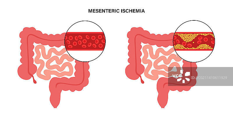 肠系膜缺血插图图片素材