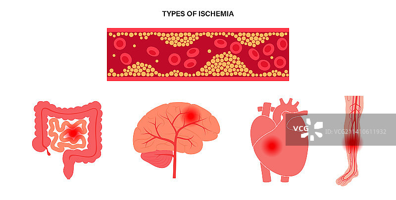 缺血类型图示图片素材