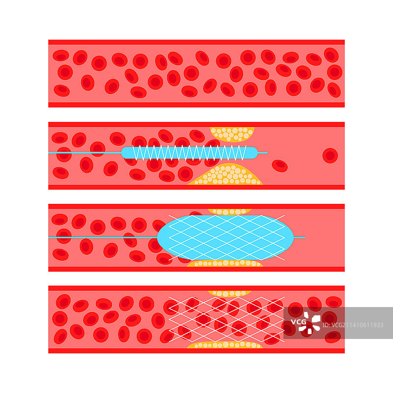 血管成形术，图示图片素材