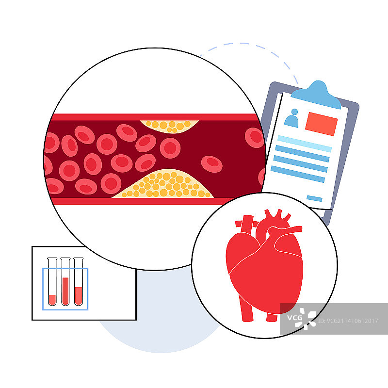 动脉粥样硬化示意图图片素材