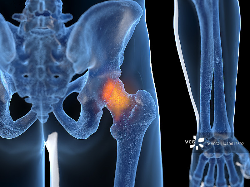 髋关节炎症插图图片素材