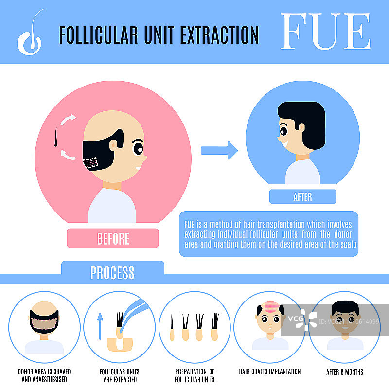 男性FUE头发移植插画图片素材