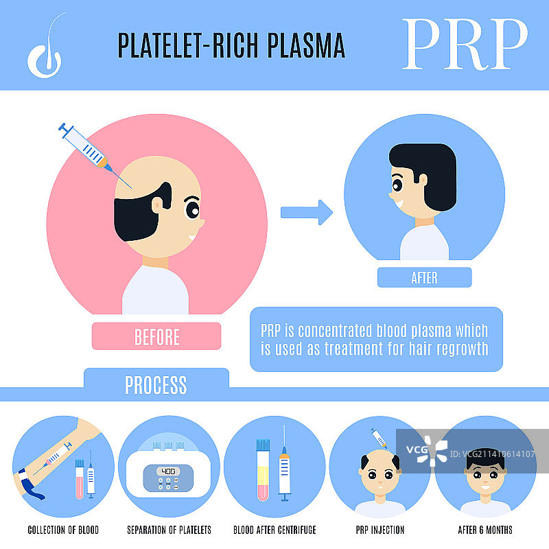 PRP男性脱发治疗插画图片素材
