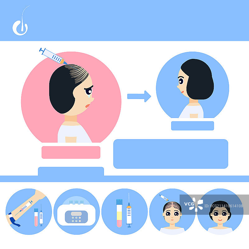 女性PRP脱发治疗插图图片素材