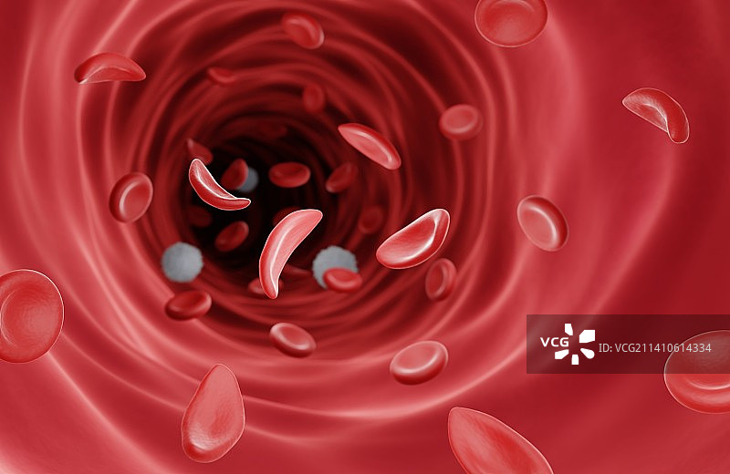 镰状细胞病插图图片素材