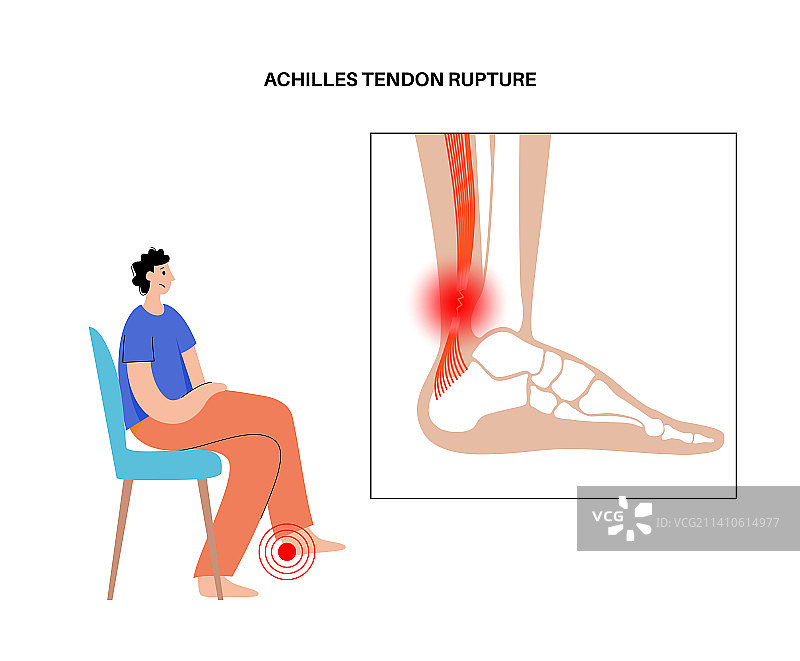 跟腱损伤插图图片素材
