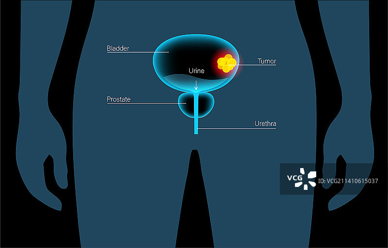 膀胱癌分期图示图片素材