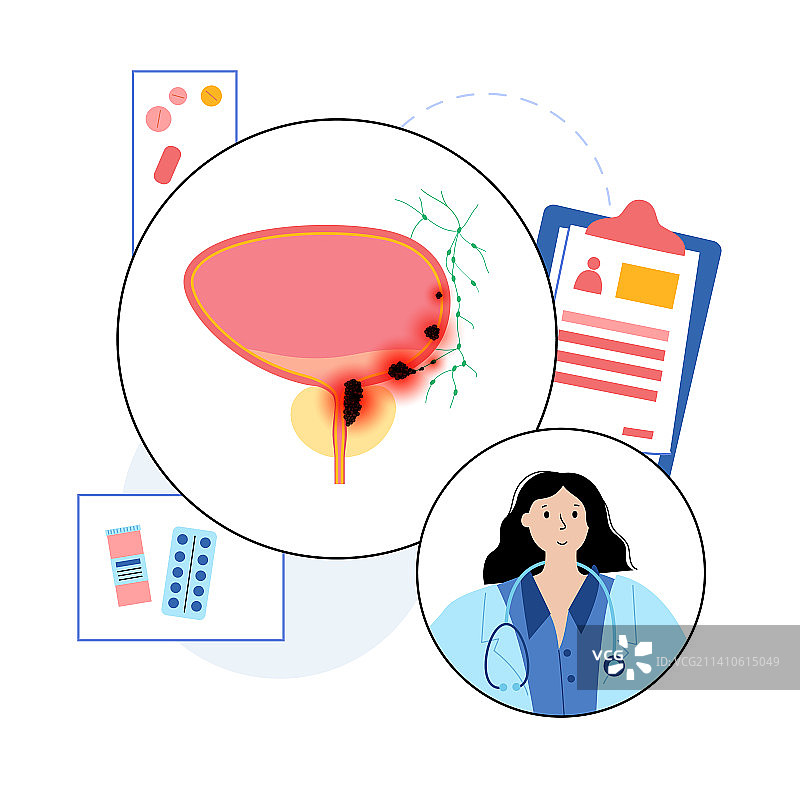膀胱癌分期图示图片素材
