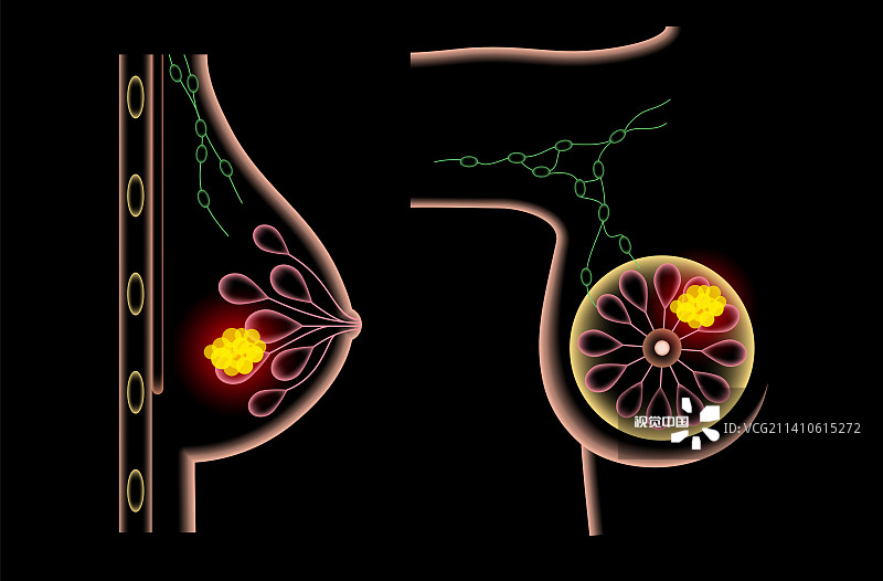 女性乳腺癌插画图片素材