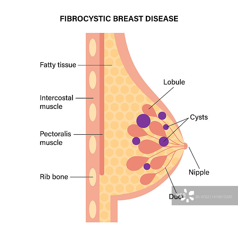纤维囊性乳腺疾病图示图片素材