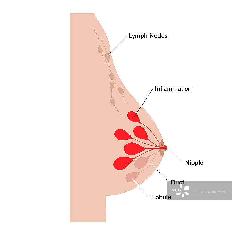 乳腺炎插图图片素材