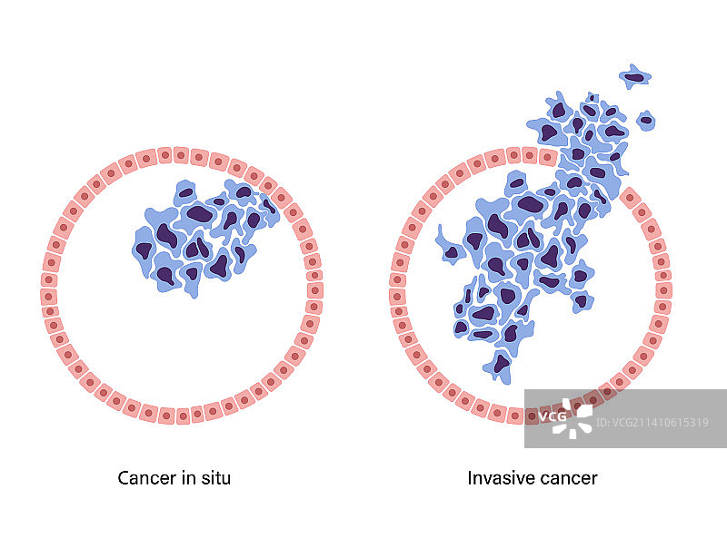 原位癌和浸润性癌图示图片素材