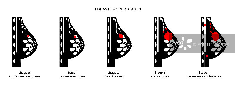 乳腺癌分期图示图片素材