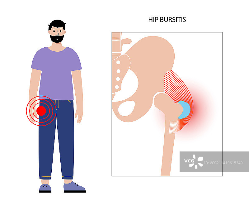 髋部滑囊炎概念图图片素材