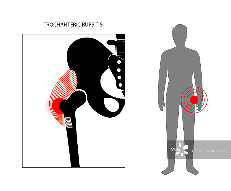 髋部滑囊炎概念图图片素材