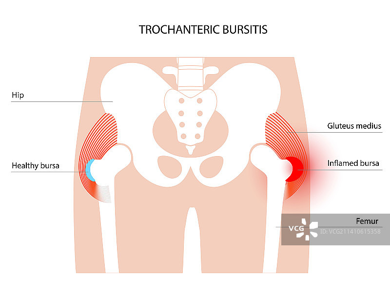 髋部滑囊炎概念图图片素材