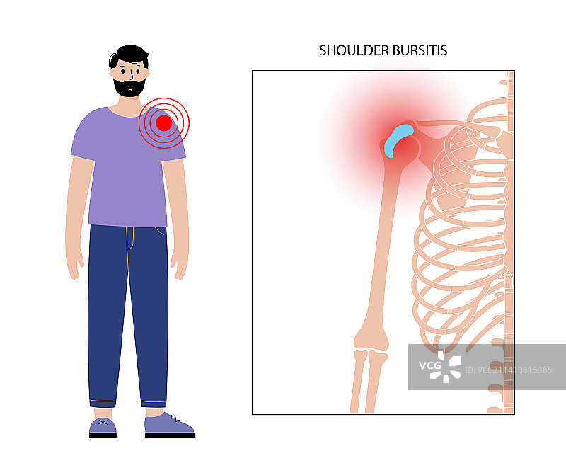 肩滑囊炎概念插画图片素材
