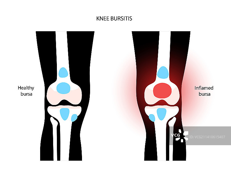 膝关节滑囊炎概念插画图片素材