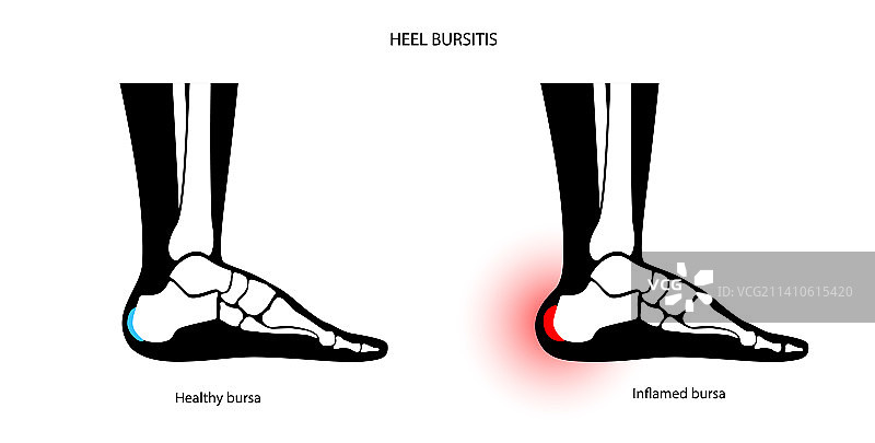 跟骨滑囊炎概念图图片素材