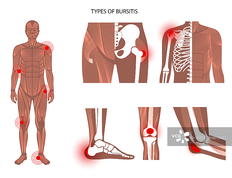 滑囊炎的类型，图示图片素材
