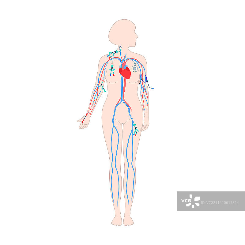 中心静脉导管，图示图片素材