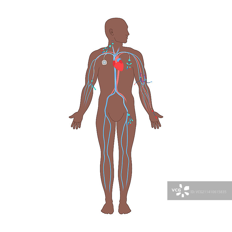 中心静脉导管，图示图片素材