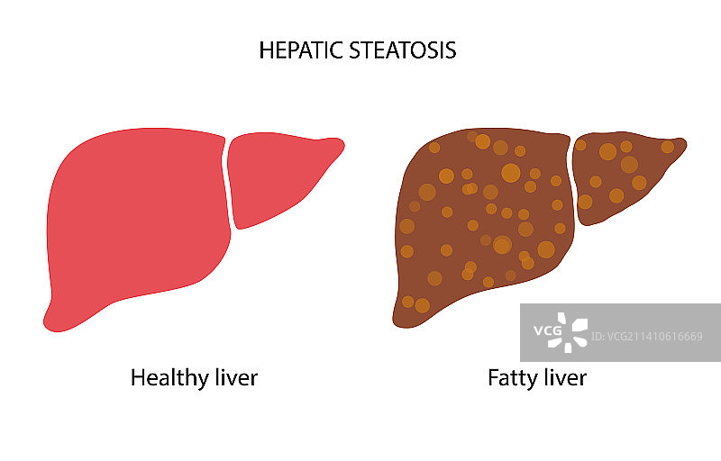 肝脏疾病插图图片素材