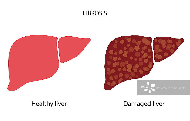 肝脏疾病插图图片素材