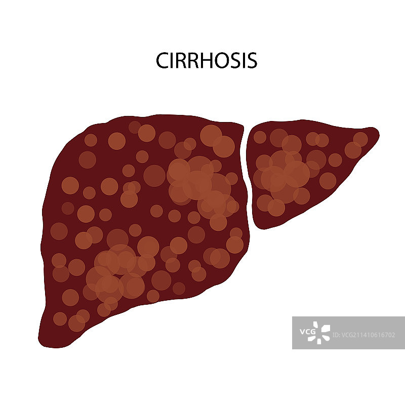 肝脏疾病插图图片素材