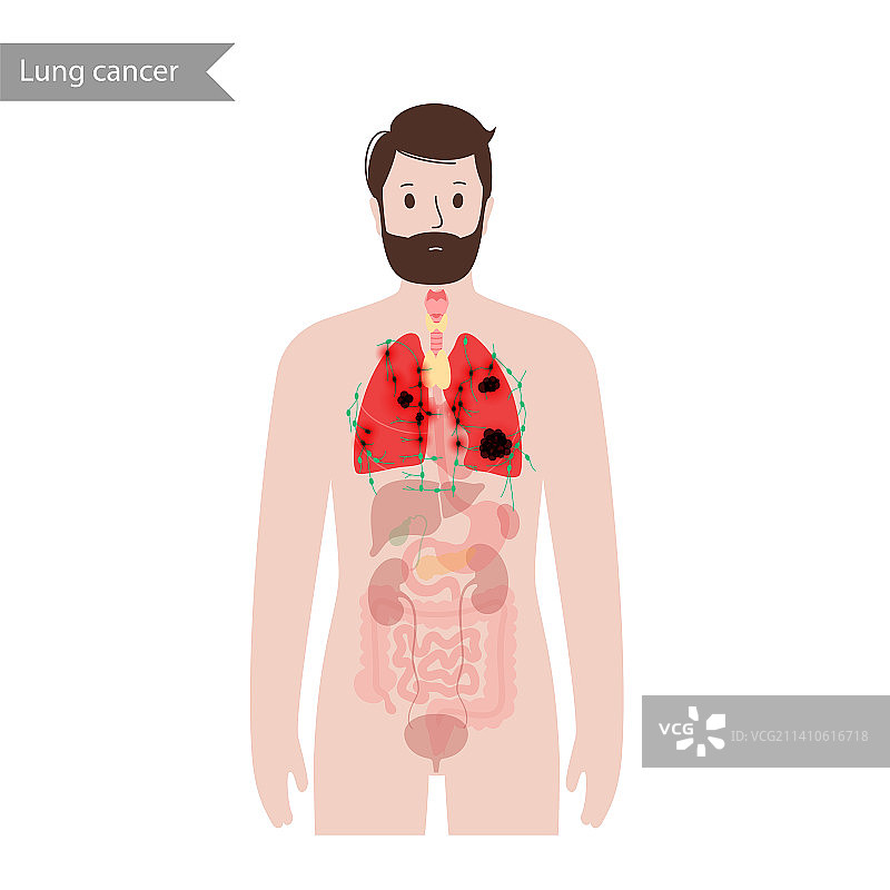肺癌插图图片素材