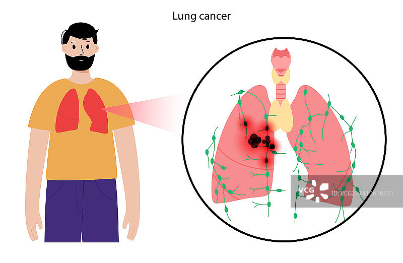 肺癌插图图片素材