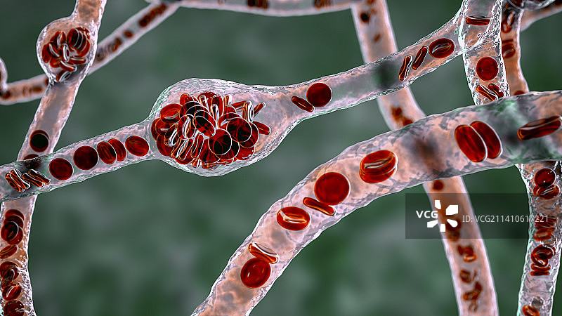 微动脉瘤插图图片素材