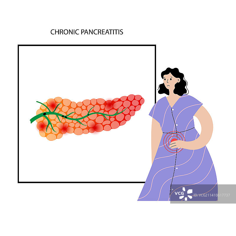 慢性胰腺炎示意图图片素材