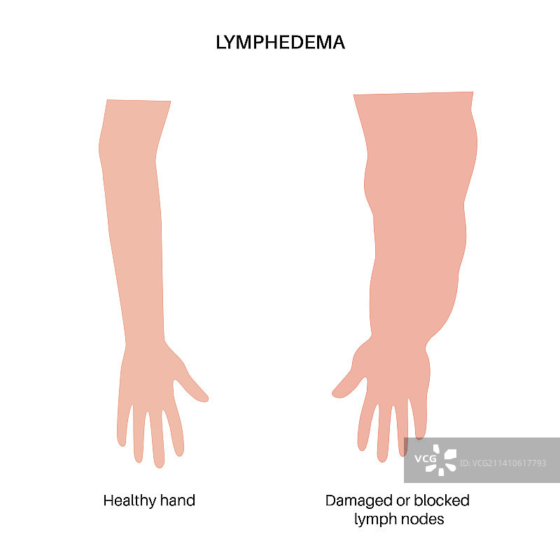 手臂淋巴水肿图图片素材