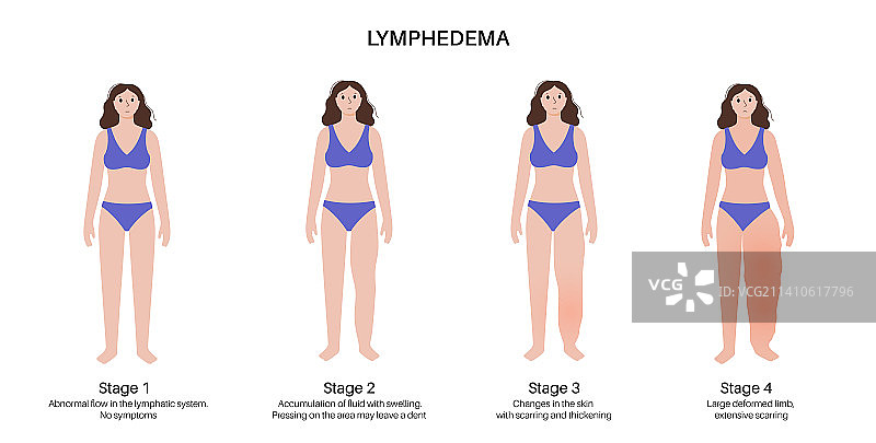 淋巴水肿分期图示图片素材