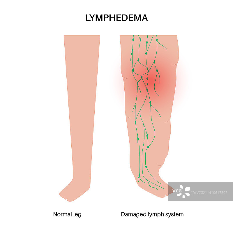淋巴水肿腿部肿胀插图图片素材