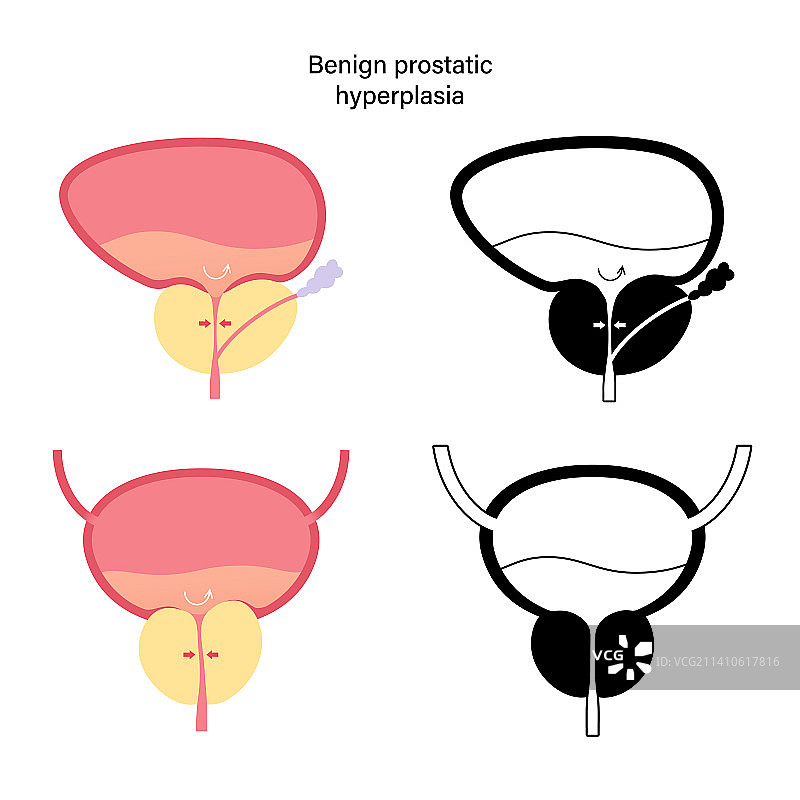 良性前列腺增生插图图片素材