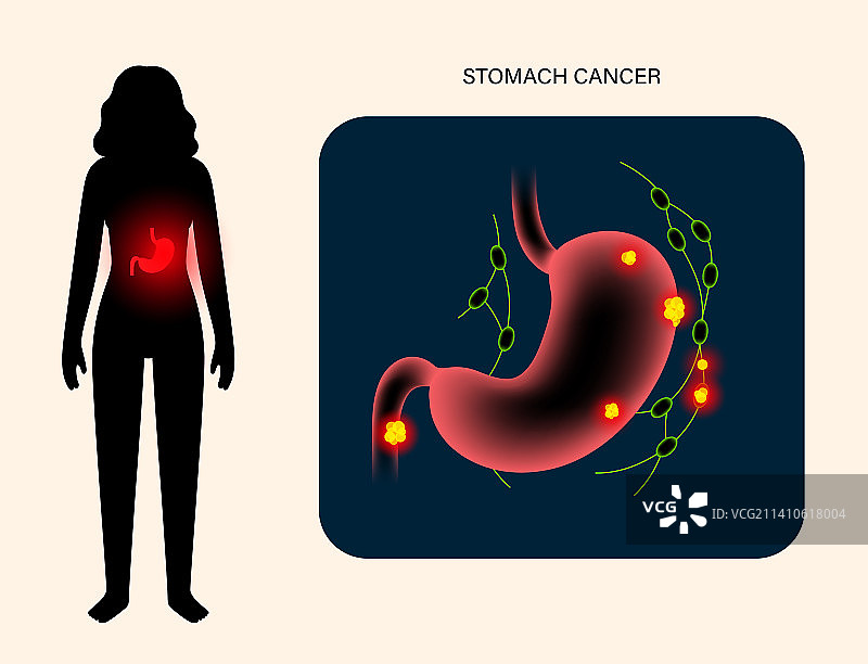 胃癌插图图片素材