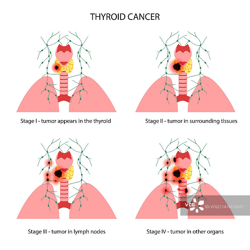 甲状腺癌分期图示图片素材